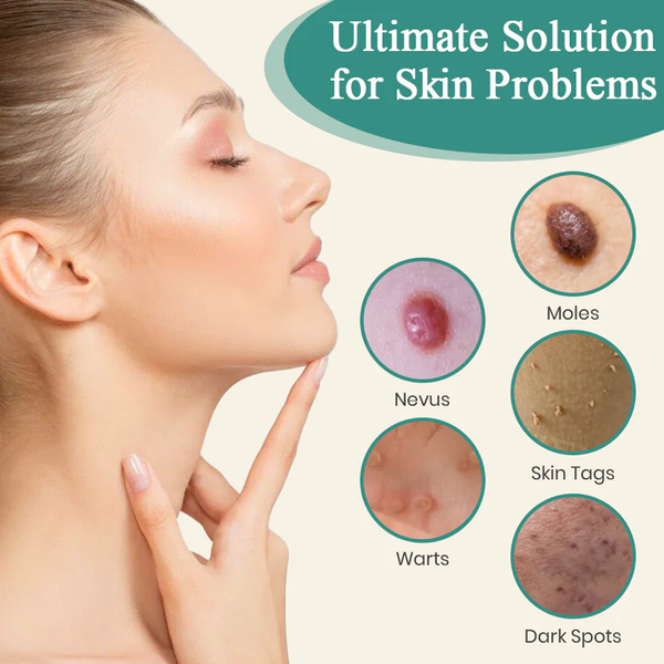 Bikenda® Mole and Wart Instant Removal Laser Pen⏳Limited-time 48% off⏰💥