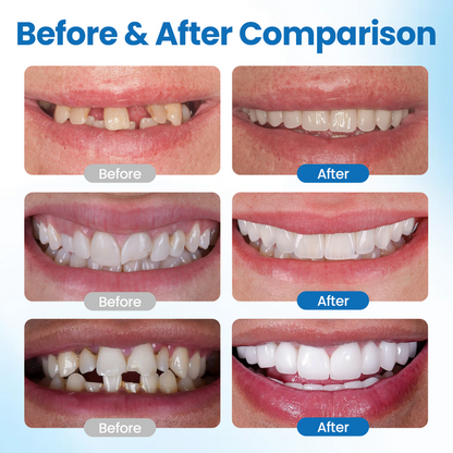 Timilk® SmileMend Tooth Repair Filling Kit⏳Limited-time 48% off⏰💥