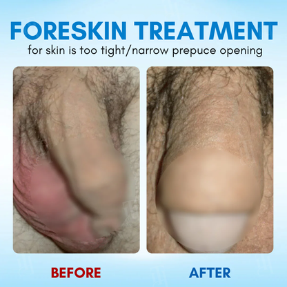 ⚡RZXEA™ Foreskin Elasticity Gel: Restore Your Edge, Restart Your Vitality.【Enough for five people!】