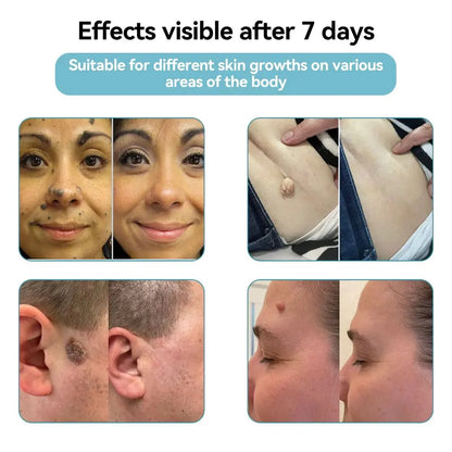 Bikenda® VelvetSkin+ Medical-Grade Laser Pen (Powered by CO₂ laser technology – effectively removes moles, warts, skin tags, pigmentation spots, and other skin imperfections)