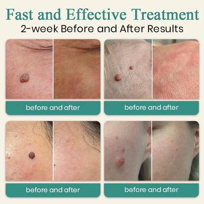 Bikenda® Mole and Wart Instant Removal Laser Pen⏳Limited-time 48% off⏰💥
