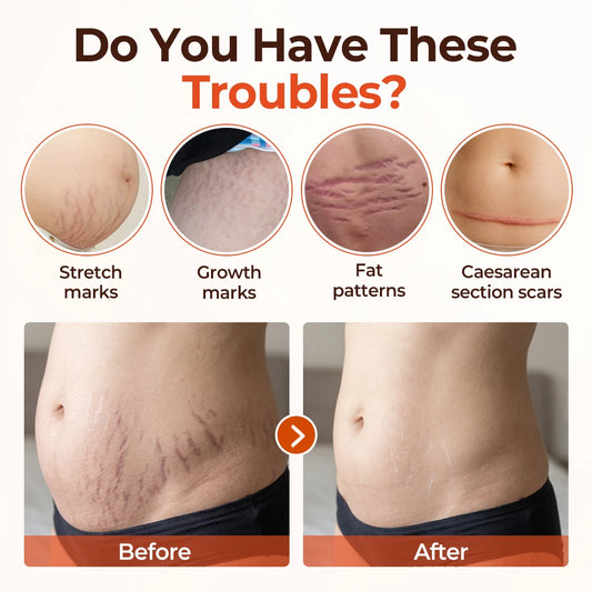 ⚡⏳Limited-time 48% off⏰💥Biancat® SilkStretch Natural Stretch Mark & Scar Oil