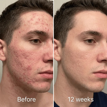 Acne Scar Invisible Repair Barrier™⚡⏳Limited-time 48% off