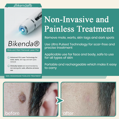 Bikenda® Mole and Wart Instant Removal Laser Pen⏳Limited-time 48% off⏰💥