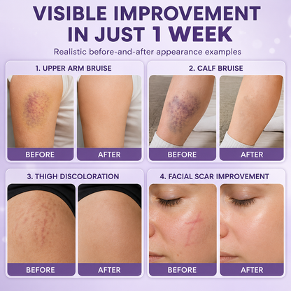 Timilk® BruiseFade Pro Skin Repair Cream⏳Limited-time 48% off⏰💥