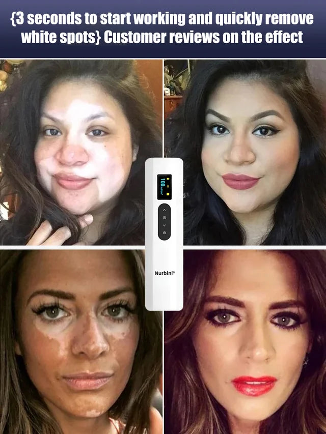 💥Nurbini® DermaBeam Vitiligo Therapy Device⏳Limited-time 48% off⏰💥