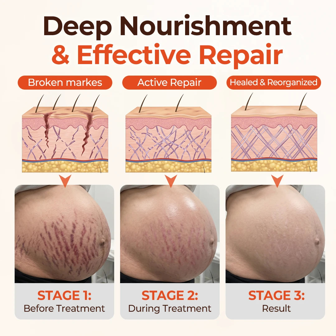 ⚡⏳Limited-time 48% off⏰💥Biancat® SilkStretch Natural Stretch Mark & Scar Oil