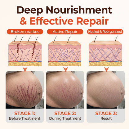 ⚡⏳Limited-time 48% off⏰💥Biancat® SilkStretch Natural Stretch Mark & Scar Oil