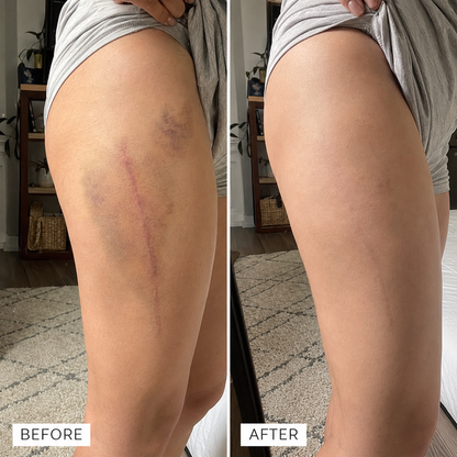 Timilk® BruiseFade Pro Skin Repair Cream⏳Limited-time 48% off⏰💥