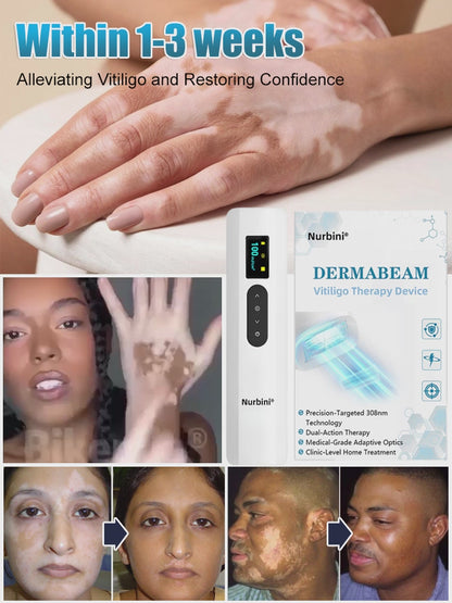 💥Nurbini® DermaBeam Vitiligo Therapy Device⏳Limited-time 48% off⏰💥