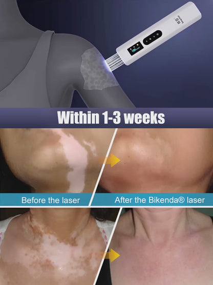 💥Nurbini® DermaBeam Vitiligo Therapy Device⏳Limited-time 48% off⏰💥